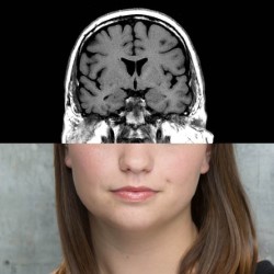Hyperthymesia